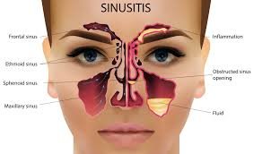Acute Sinusitis