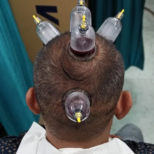 HIJAMA FOR HAIR LOSS & ALOPECIA