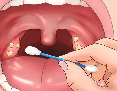 HOMOEOPATHY FOR TONSILLITIS
