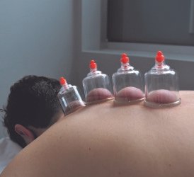 Hijama Cupping Therapy for Anxiety & Depression