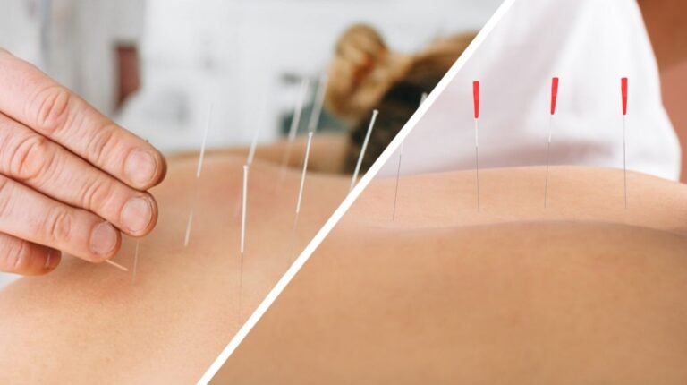 Traditional Body Acupuncture