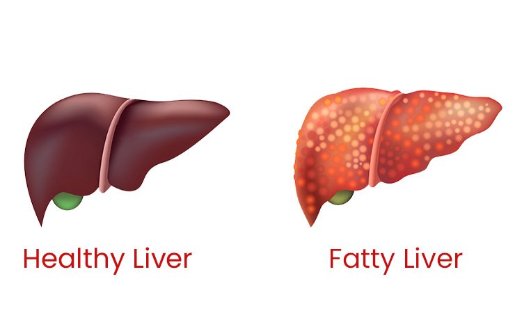 Homeopathy for Fatty Liver Disease