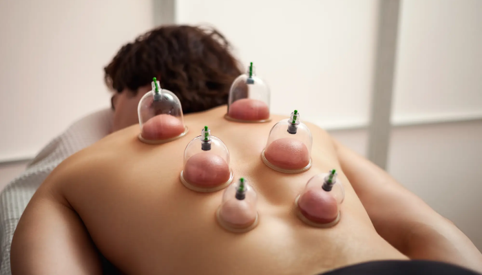 Cupping and Moxibustion