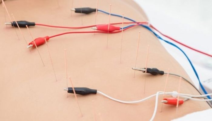Electroacupuncture