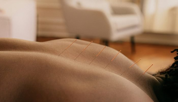 acupunture at House of Nature Medical Center in Abu Dhabi