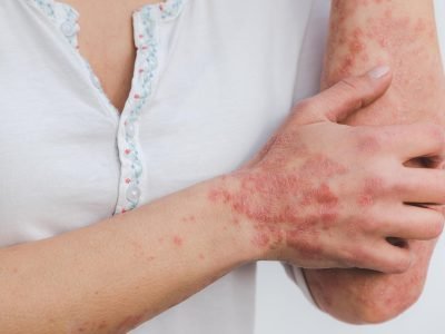 skin diseases